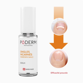 Poderm Ongles incarnés apaisant