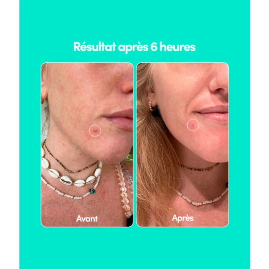 Merci Handy Patch boutons Purifie & Cicatrise 24 patchs étoiles, coeurs et nuages