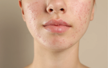 Acné et soleil : quels soins utiliser en été pour éviter les boutons ?
