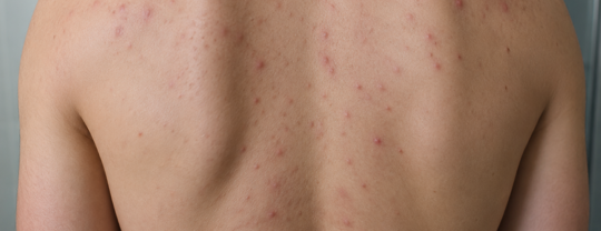 Acné du dos et du décolleté : quelle routine pour éliminer les boutons ?