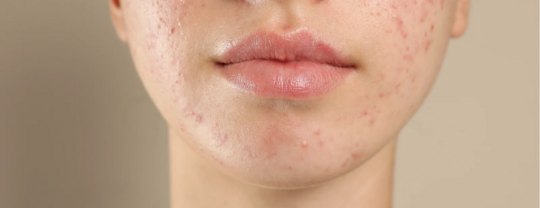 Acné et soleil : quels soins utiliser en été pour éviter les boutons ?